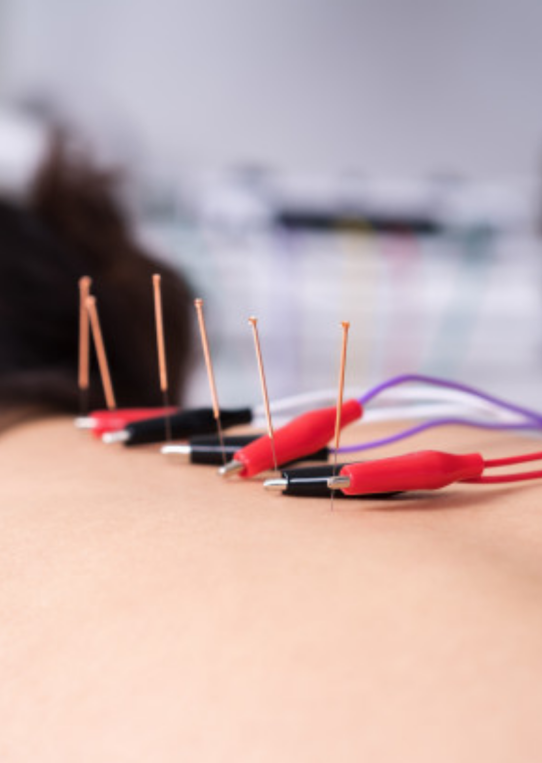 iii-curso-electroneuroacupuntura